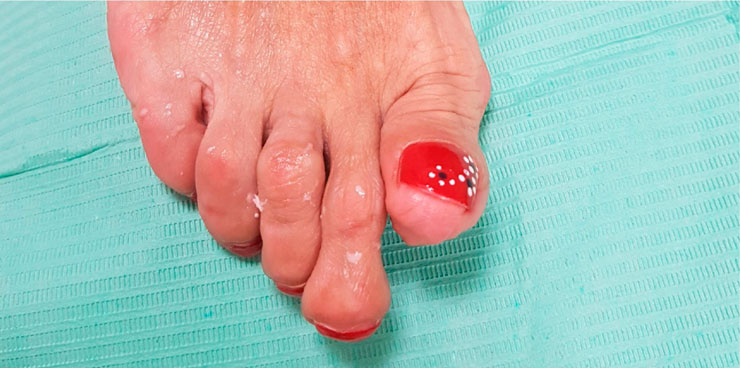 Podología. Prótesis de silicona para los pies 1