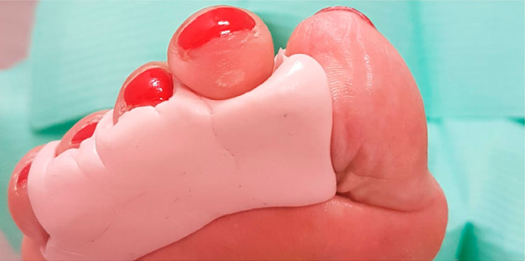 Podología. Prótesis de silicona para los pies 2